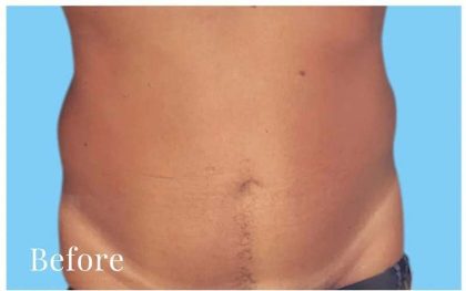 Daddy Makeover Before & After Patient #2521