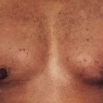 Gynecomastia Before & After Patient #2710