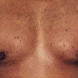 Gynecomastia Before & After Patient #2710