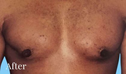 Gynecomastia Before & After Patient #2710