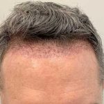 Hair Restoration Before & After Patient #2760