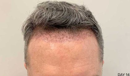 Hair Restoration Before & After Patient #2760