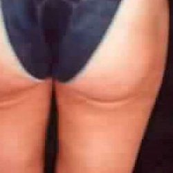 Liposuction Before & After Patient #2838