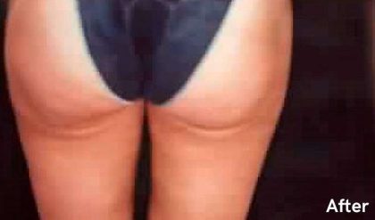Liposuction Before & After Patient #2838