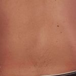 Liposuction Male Before & After Patient #2897
