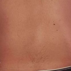 Liposuction Male Before & After Patient #2897
