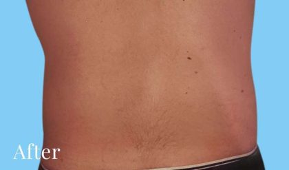 Liposuction Male Before & After Patient #2897