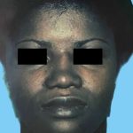 Rhinoplasty Before & After Patient #2970