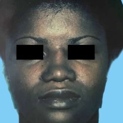 Rhinoplasty Before & After Patient #2970
