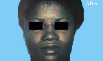 Rhinoplasty Before & After Patient #2970
