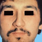 Rhinoplasty Male Before & After Patient #3018