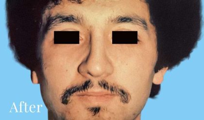 Rhinoplasty Male Before & After Patient #3018