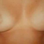 Breast Asymmetry Correction Before & After Patient #2175