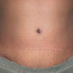 Tummy Tuck Before & After Patient #3057