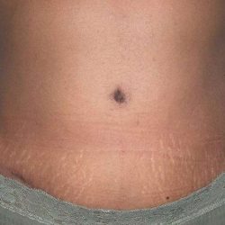 Tummy Tuck Before & After Patient #3057