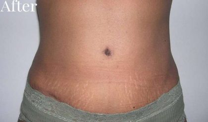 Tummy Tuck Before & After Patient #3057