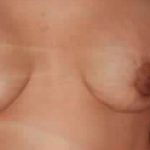 Breast Lift Before & After Patient #2273