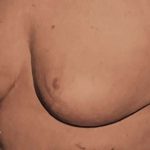 Breast Reduction Before & After Patient #2357