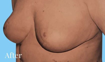 Breast Reduction Before & After Patient #2357