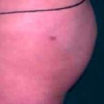 Buttock Augmentation Before & After Patient #2405