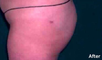 Buttock Augmentation Before & After Patient #2405