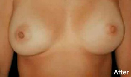 Breast Asymmetry Correction Before & After Patient #2175