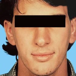 Otoplasty Male Before & After Patient #2538