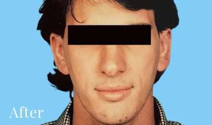 Otoplasty Male Before & After Patient #2538