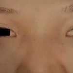 Eyelid Surgery Before & After Patient #2611