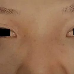 Eyelid Surgery Before & After Patient #2611
