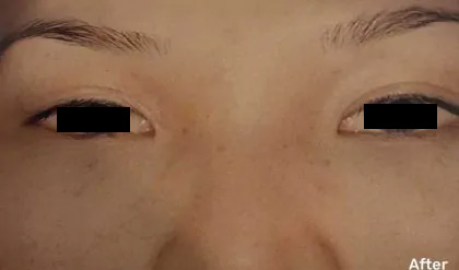 Eyelid Surgery Before & After Patient #2611