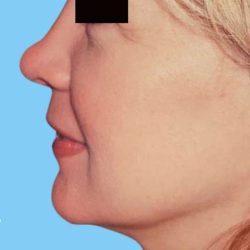 Facelift Before & After Patient #2647