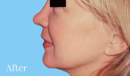 Facelift Before & After Patient #2647