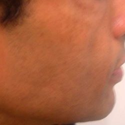 Fat Transfer Male Before & After Patient #2683