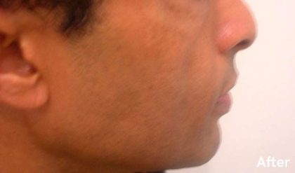 Fat Transfer Male Before & After Patient #2683