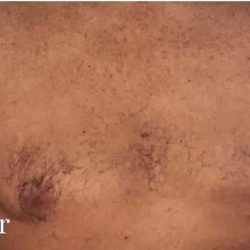 Daddy Makeover Before & After Patient #2511