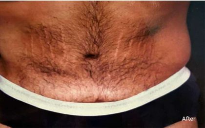 Daddy Makeover Before & After Patient #2511