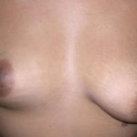 Breast Augmentation Before & After Patient #2216