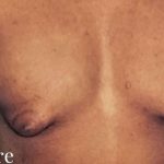 Gynecomastia Before & After Patient #2710
