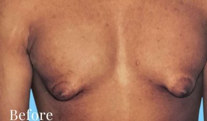 Gynecomastia Before & After Patient #2710