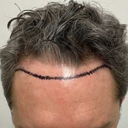 Hair Restoration Before & After Patient #2760