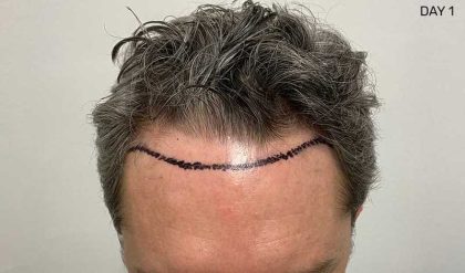 Hair Restoration Before & After Patient #2760