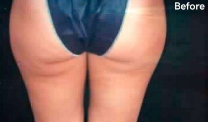 Liposuction Before & After Patient #2838