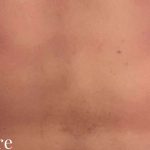 Liposuction Male Before & After Patient #2897