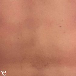 Liposuction Male Before & After Patient #2897