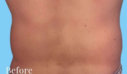 Liposuction Male Before & After Patient #2897