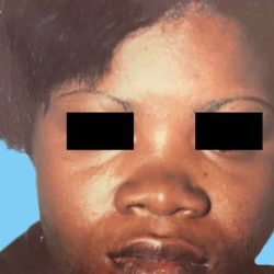 Rhinoplasty Before & After Patient #2970