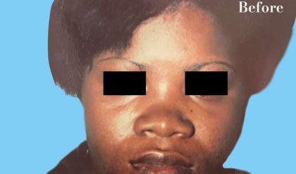 Rhinoplasty Before & After Patient #2970