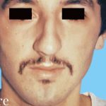 Rhinoplasty Male Before & After Patient #3018