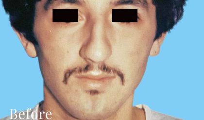 Rhinoplasty Male Before & After Patient #3018